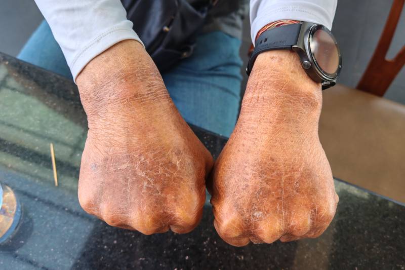 sunburn hands, Everest Base Ca,p trek